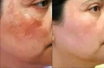 Angel Melasma Cream - Image 2